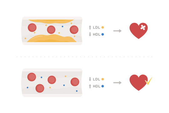 Efectos del colesterol bueno y malo, HDL y LDL, salud del coraz&oacute;n. Infograf&iacute;a vasos sangu&iacute;neos., placa de colesterol, eritrocitos, arterias, flujo sangu&iacute;neo, salud cardiovascular riesgo cardiovascular