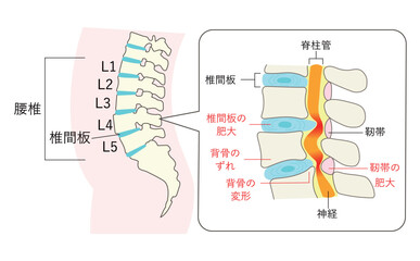 脊柱管狭窄症になった腰椎の説明イラスト拡大図