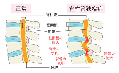 正常な腰椎と脊柱管狭窄症の比較イラスト
