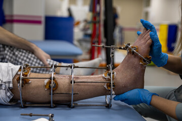 Ilizarov apparatus on the leg. A man with a sore leg is examined by a doctor.