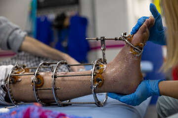 Ilizarov apparatus on the leg. A man with a sore leg is examined by a doctor.