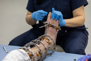 Ilizarov apparatus on the leg. A man with a sore leg is examined by a doctor.
