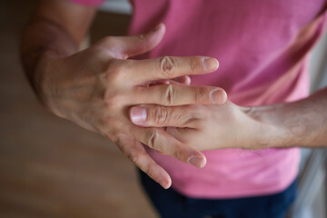 The man's hand, he uses steroids Apply External type.