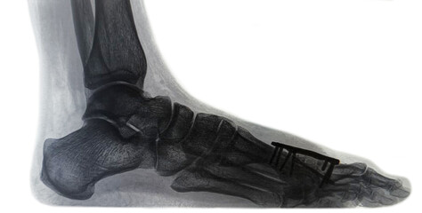 Xray image of Bone block distraction arthrodesis - MTP1 of the hallux metatarsophalangeal joint after resection arthroplasty. female foot after surgery - standing position with minimal load, pressure - obrazy, fototapety, plakaty