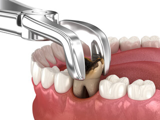Extraction of Molar tooth damaged by caries. Dental 3D illustration - obrazy, fototapety, plakaty