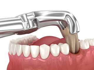 Extraction of Molar tooth damaged by caries. Dental 3D illustration - 588292050