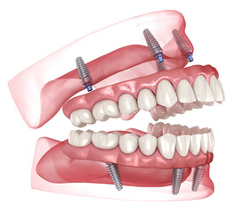 Dental prosthesis based on 4 implants. Dental 3D illustration