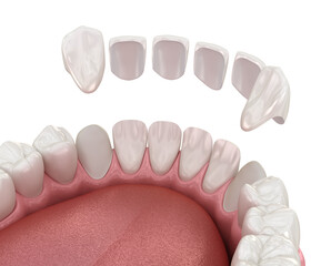 Dental veneer placement over frontal teeth. 3D illustration - 588292212