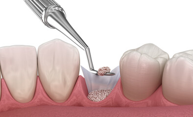 Augmentation Surgery - Adding artificial bone after tooth extraction. 3D illustration