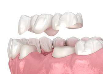 Dental bridge based on 2 teeth. 3D illustration