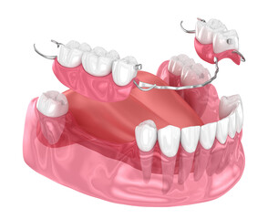 Removable partial denture, mandibular prosthesis. Medically accurate 3D illustration of prosthodontics concept