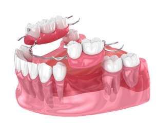 Removable partial denture, mandibular prosthesis. Medically accurate 3D illustration of prosthodontics concept