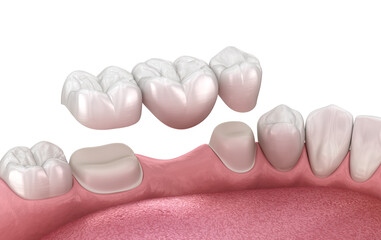 Dental bridge based on 2 teeth. 3D illustration - 588292279