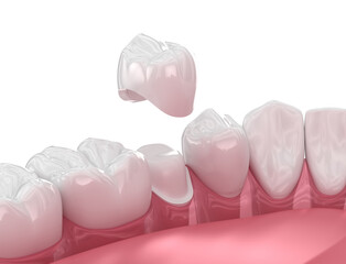 Dental crown placement over tooth. 3D illustration - 588292290