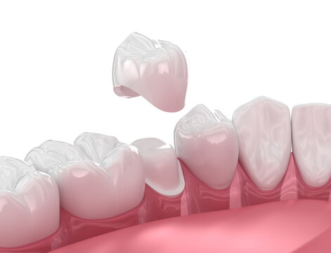 Dental crown placement over tooth. 3D illustration