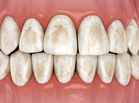 Tooth demineralization, removal of minerals from hard tissues: enamel, dentine, and cementu. Dental 3D illustration