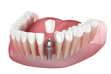Dental implant and ceramic crown. Medically accurate tooth 3D illustration.