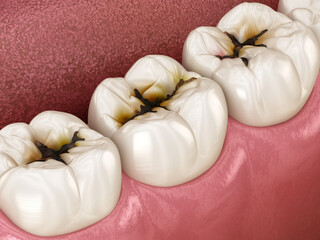 Molar teeth damaged by caries. Dental 3D illustration - 588292807