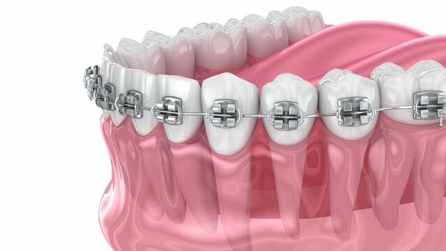 Cuspid correction with braces. Medically accurate dental 3D animation