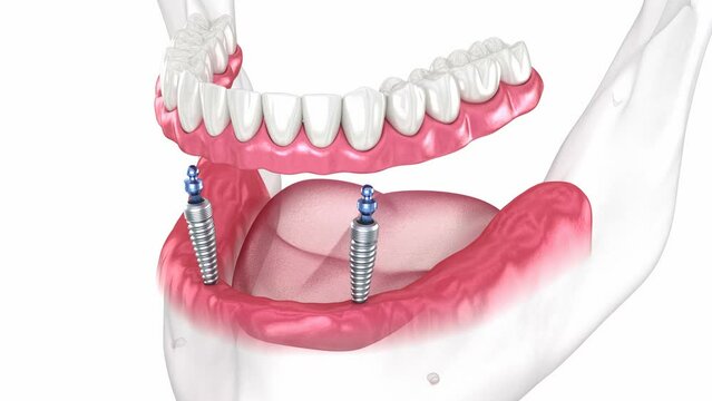 Mandibular removable prosthesis All on 2 system supported by implants with ball attachments. Dental 3D animation