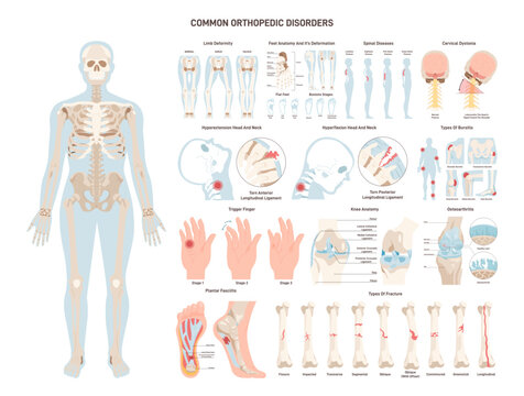 Orthopedic diseases set. Human skeleton, ligament and joints injuries