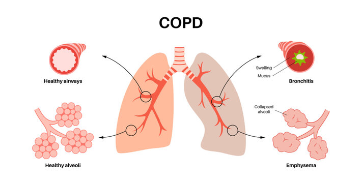 Chronic obstructive pulmonary disease