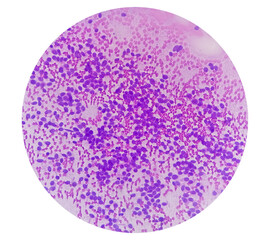 USG guided FNA cytology of liver SOL showing Non Hodgkin lymphoma. Metastatic carcinoma.