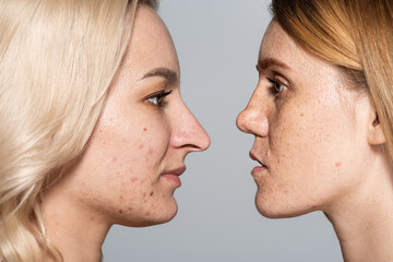 profile of women with problem skin standing face to face isolated on grey.