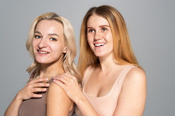 Smiling women with skin issues standing isolated on grey.
