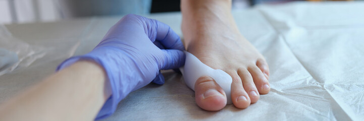 Valgus deformity of the foot and fixator for treatment closeup - obrazy, fototapety, plakaty