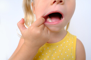 close-up of small child, blonde girl 3 years old in yellow dress shows teeth, visit to dentist for examination oral cavity, control of milk teeth, temporary teeth, concept of caries prevention