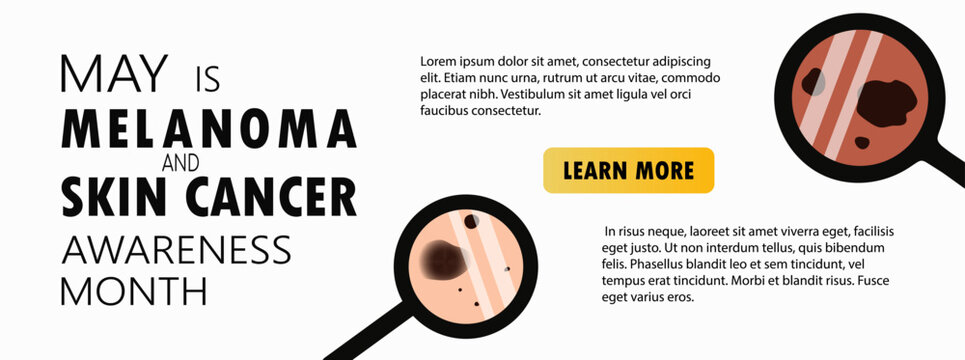 Melanoma and skin cancer awareness month landing page template. Banner template with moles, birthmarks under magnifying glass and copy space for text. Vector illustration