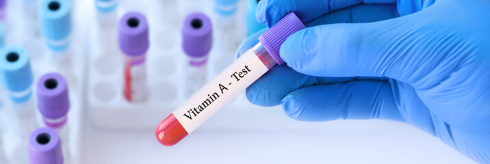 Doctor holding a test blood sample tube with Vitamin A test on the background of medical test tubes with analyzes.Banner.