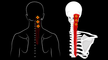 Semispinalis muscles. Trigger points. Headache, neck pain and back pain