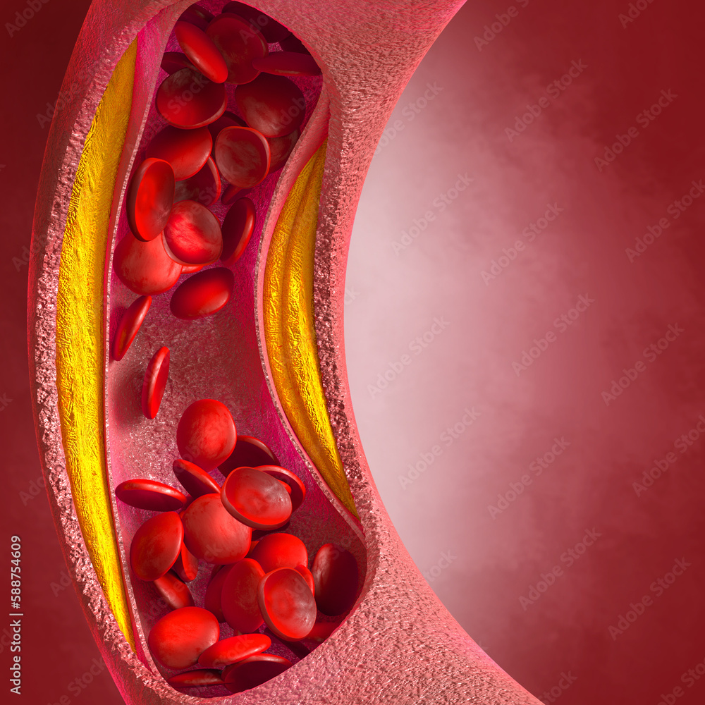 Wall mural Medical background, cholesterol plaque in the artery, increased level, 3d illustration