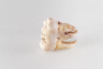 Fototapeta na wymiar Geminated number 48 lower wisdom tooth posed on a white background. Dental phenomenon that appears to be two teeth developed from one. 