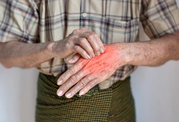 Asian man scratching his hand. Concept of itchy skin diseases such as scabies, fungal infection,...