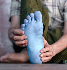 Light blue colored sole of Asian man. Concept of tingling and numbness or cold and clumsy foot.