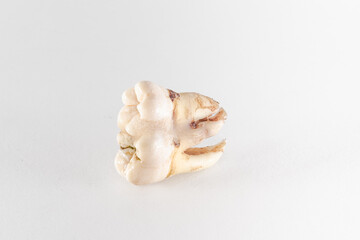 Geminated number 48 lower wisdom tooth posed on a white background. Dental phenomenon that appears to be two teeth developed from one. 