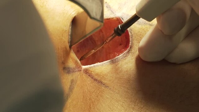 Breast woman surgery augmentation implants patient hospital doctor