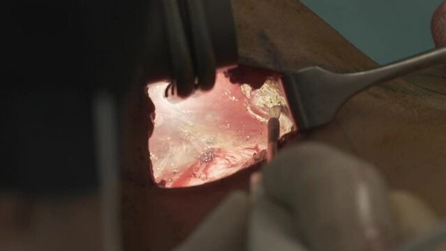 Breast woman surgery augmentation implants patient hospital doctor