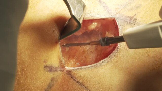 Breast woman surgery augmentation implants patient hospital doctor