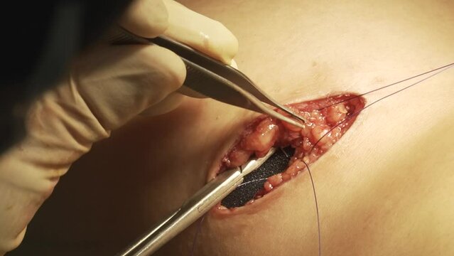 Breast woman surgery augmentation implants patient hospital doctor