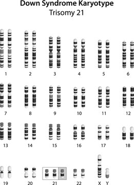 Down syndrome (trisomy 21) human karyotype