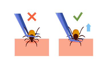 Removing encephalitis ticks after bite. How to remove mite. Parasite carrying disease. Tick grabbed into skin, it is removed with tweezers. First aid. Prevention of infections transmitted by mites