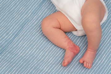 Hemangioma red birthmark on leg of newborn baby