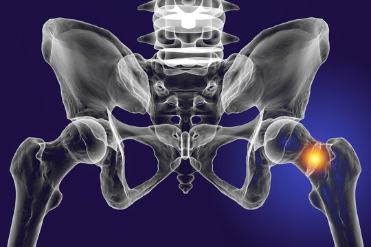 A Fracture Of The Femur Neck, A Common Type Of Hip Fracture That Typically Occurs In Older Adults And Can Lead To Mobility Issues And Other Complications, 3D Illustration