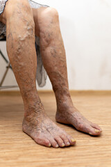 Vertical cropped elderly woman bare legs with exposed spider varicose veins on thin edema skin and...