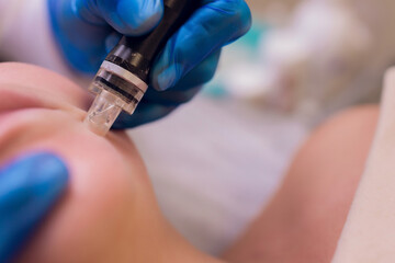 Woman cleaning nose skin pores using vacuum blackhead remover, cosmetic procedure.