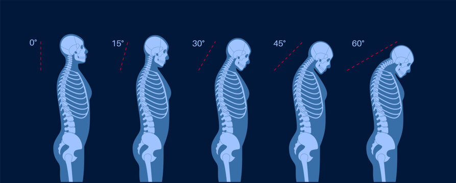 Neck vertebrae deformity